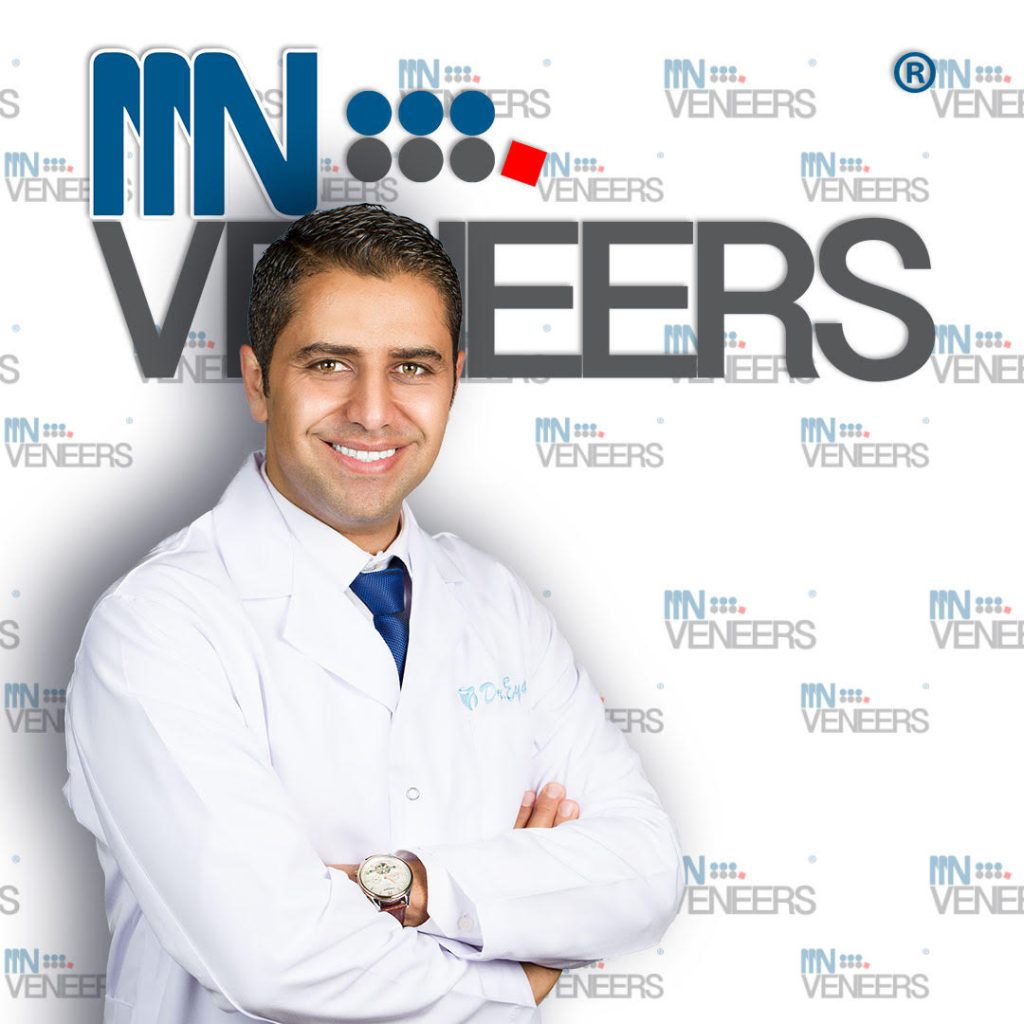 ציפויים וויניר ולומיניר nnnveneers | מרפאת שיניים ד"ר שאדי עיאדאת חדרה