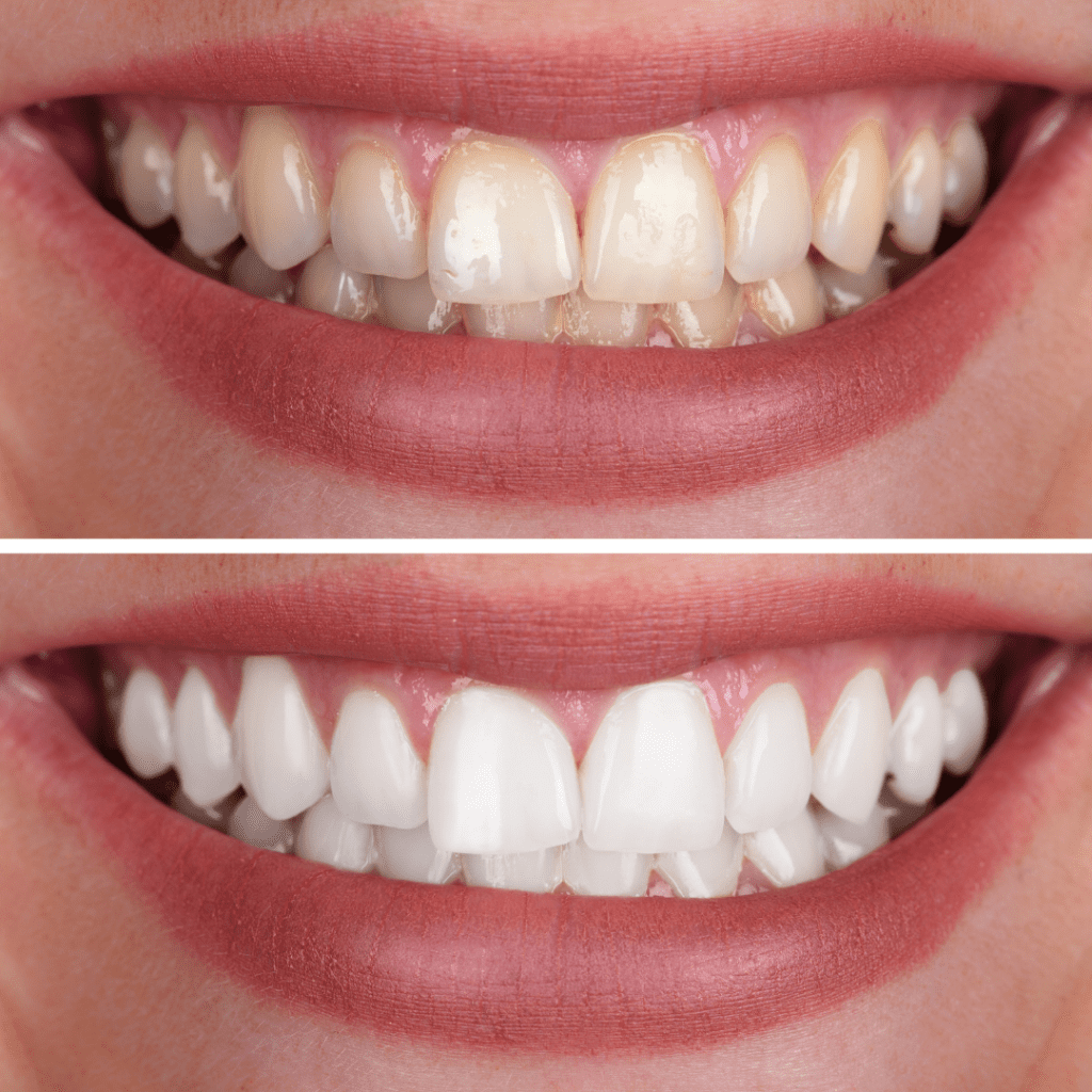 הלבנת שיניים מרפאת שיניים ד"ר שאדי עיאדאת