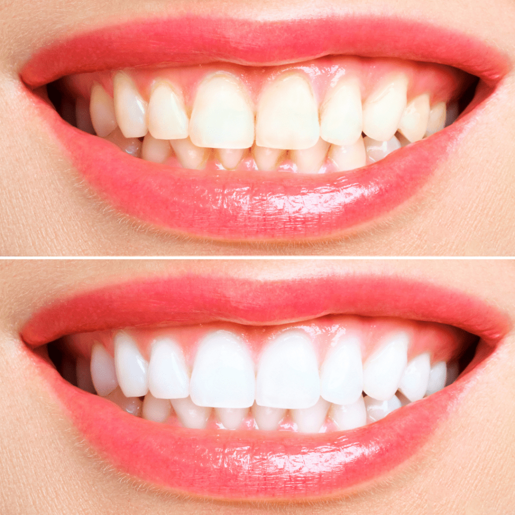 הלבנת שיניים בשיטת ZOOM | מרפאת שיניים ד"ר שאדי עיאדאת |