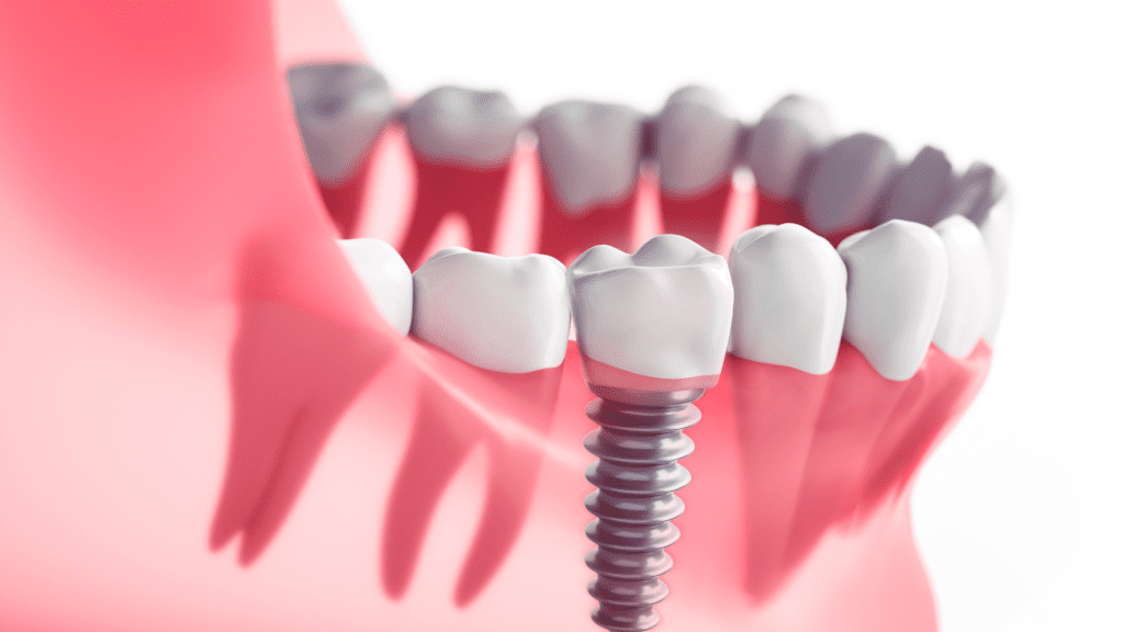 שתלים דנטליים לשיניים | מרפאת שיניים ד"ר שאדי עיאדאת |