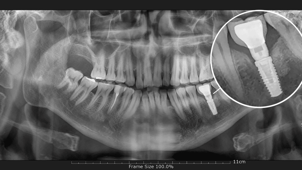 שתלים דנטליים לשיניים | מרפאת שיניים ד"ר שאדי עיאדאת |